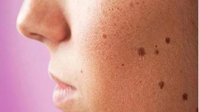 How to get rid of dark spots on the face naturally